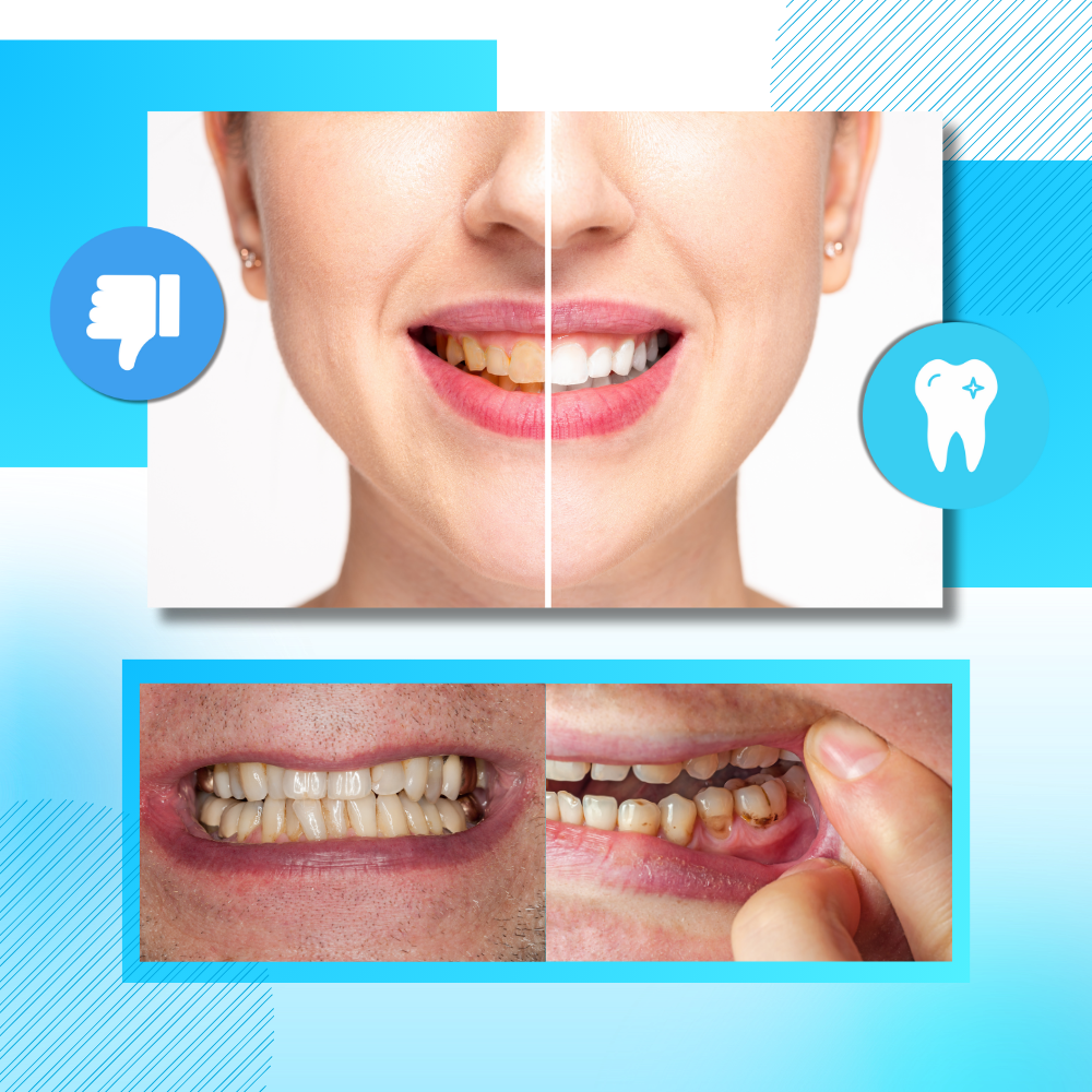 Tandblekningsremsor med kol - Ozerty
