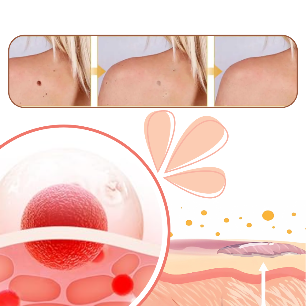 Icke-invasiv behandling för hudflikar och vårtor - Ozerty