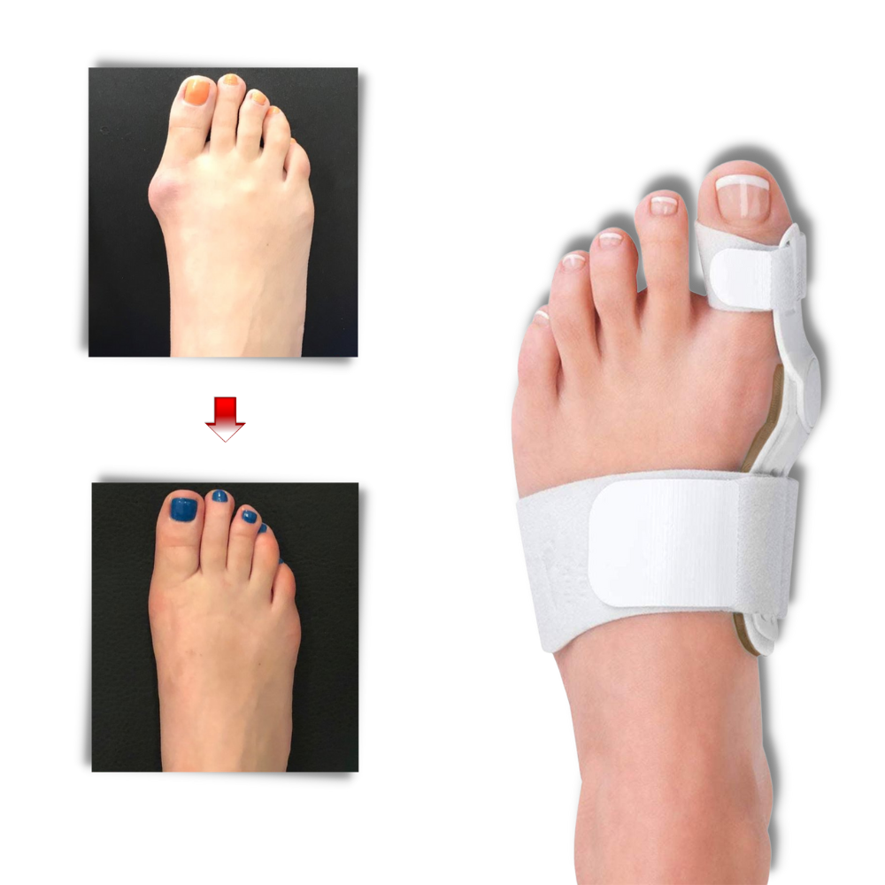 Ortopedisk Hallux valgus-stöd - Ozerty