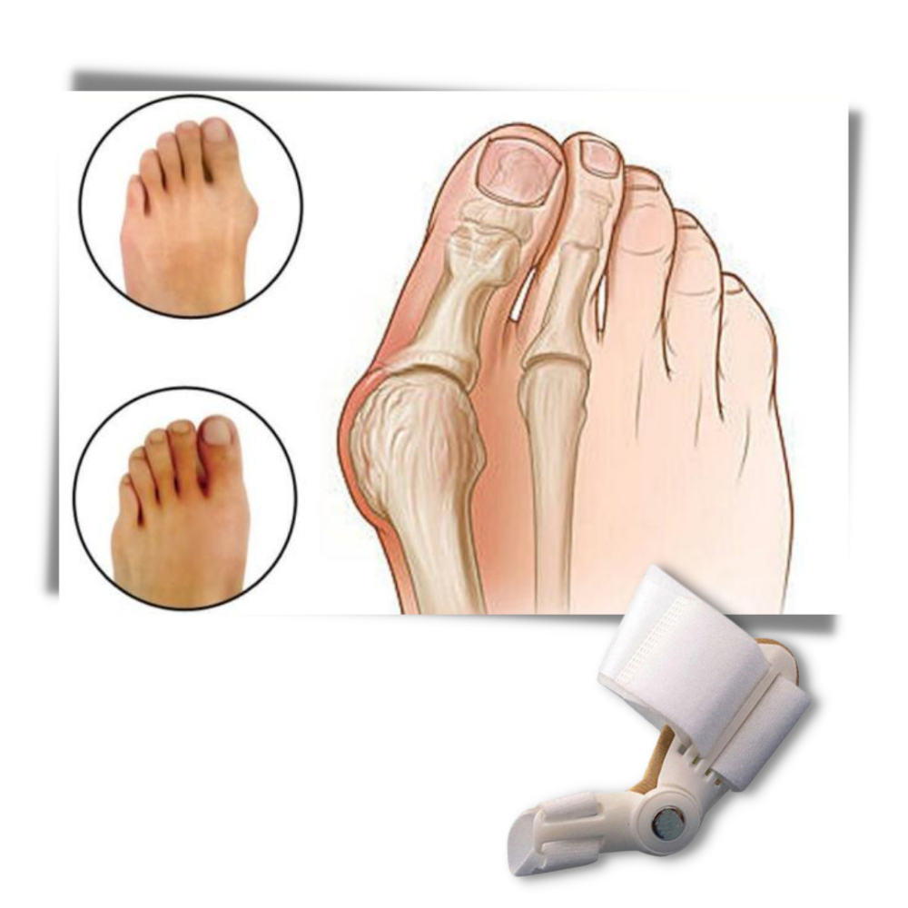 Ortopedisk Hallux valgus-stöd - Ozerty