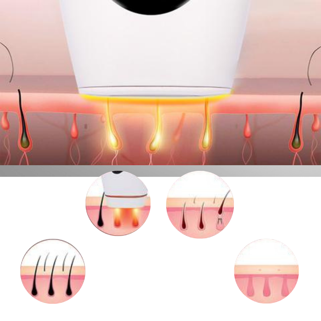 IPL laser hårborttagning Handset - Ozerty