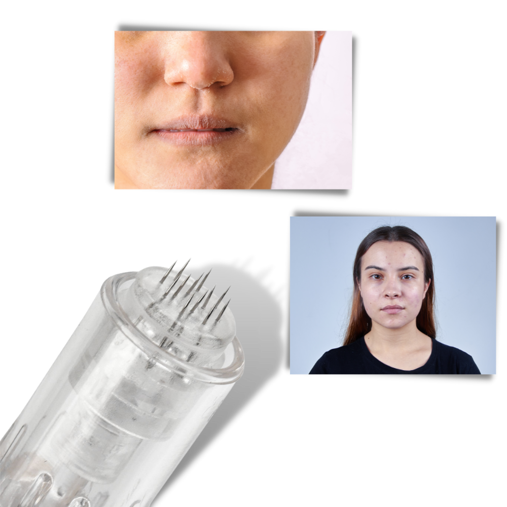 Dermal micro-needling penna - Ozerty